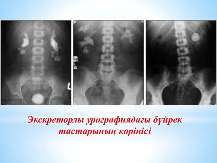 Экскреторлы урографиядағы бүйрек тастарының көрінісі