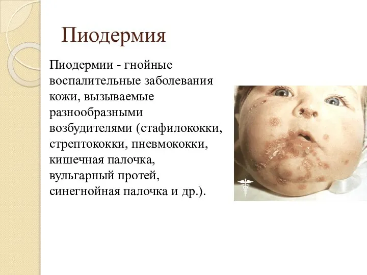 Пиодермия Пиодермии - гнойные воспалительные заболевания кожи, вызываемые разнообразными возбудителями (стафилококки,