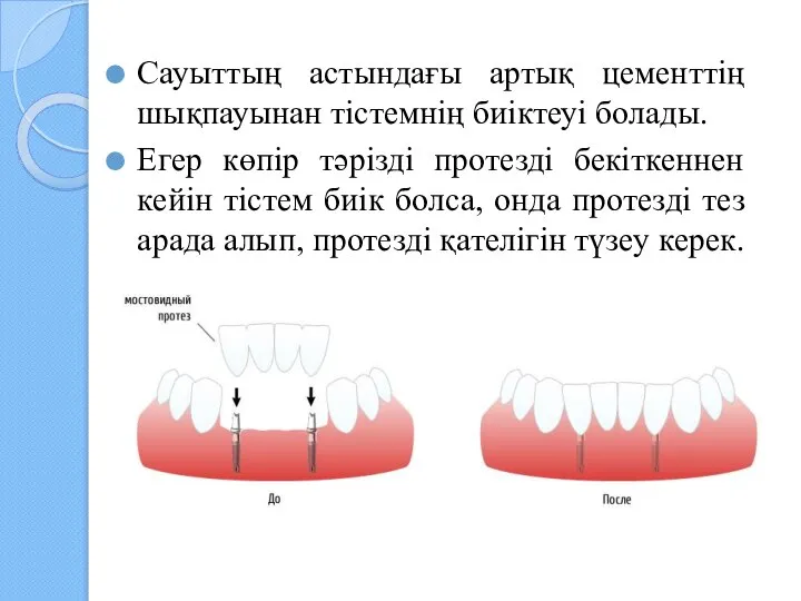 Сауыттың астындағы артық цементтің шықпауынан тістемнің биіктеуі болады. Егер көпір тәрізді