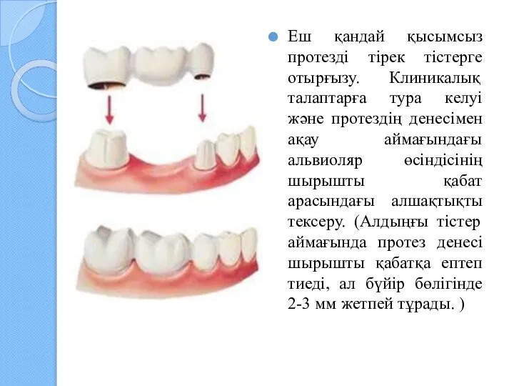 Еш қандай қысымсыз протезді тірек тістерге отырғызу. Клиникалық талаптарға тура келуі