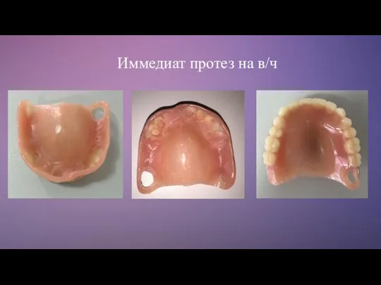 Иммедиат протез на в/ч