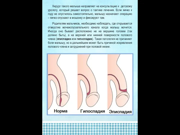 Хирург такого малыша направляет на консультацию к детскому урологу, который решает