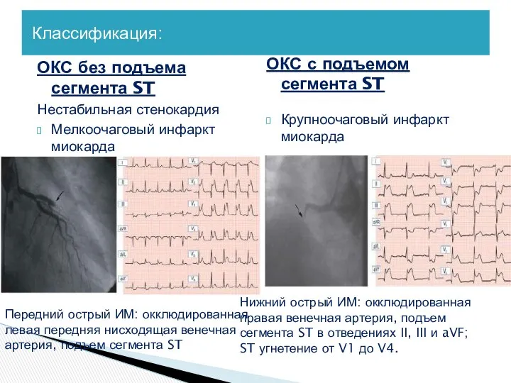 Классификация: ОКС без подъема сегмента ST Нестабильная стенокардия Мелкоочаговый инфаркт миокарда