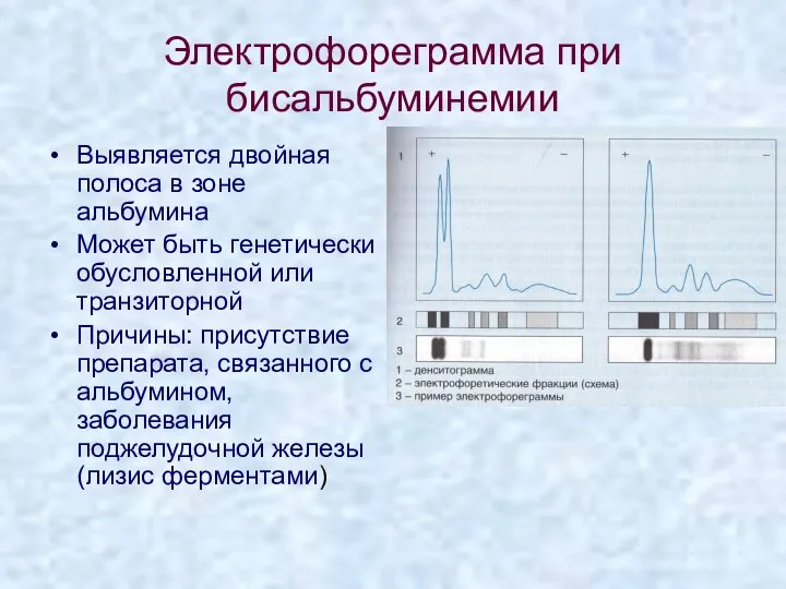 Электрофореграмма при бисальбуминемии Выявляется двойная полоса в зоне альбумина Может быть