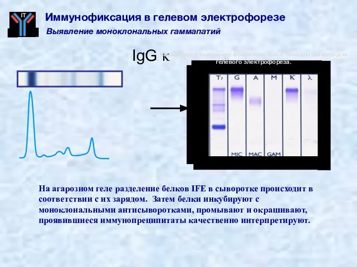 IgG κ Выявление моноклональных гаммапатий Иммунофиксация в гелевом электрофорезе На агарозном