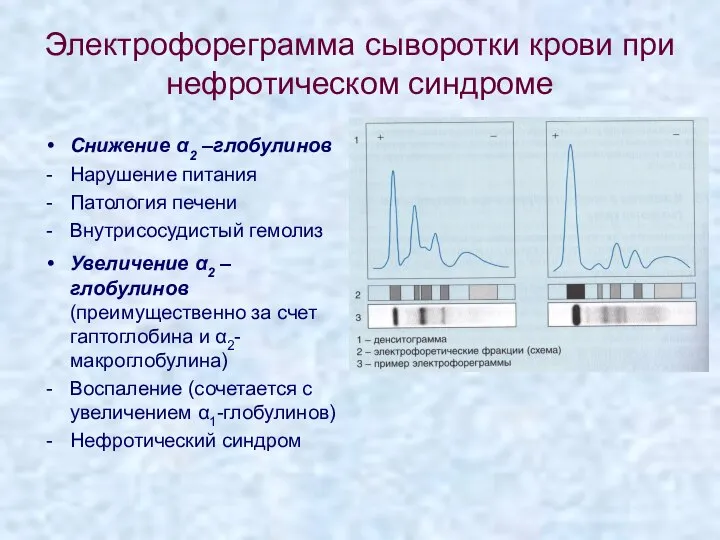 Электрофореграмма сыворотки крови при нефротическом синдроме Снижение α2 –глобулинов Нарушение питания