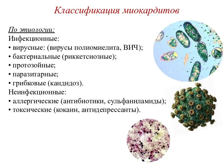 Классификация миокардитов По этиологии: Инфекционные: • вирусные: (вирусы полиомиелита, ВИЧ); •