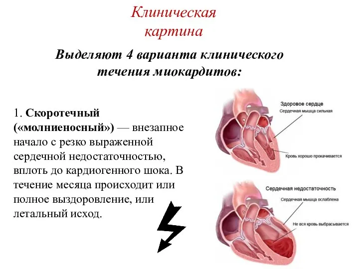 Клиническая картина 1. Скоротечный («молниеносный») — внезапное начало с резко выраженной