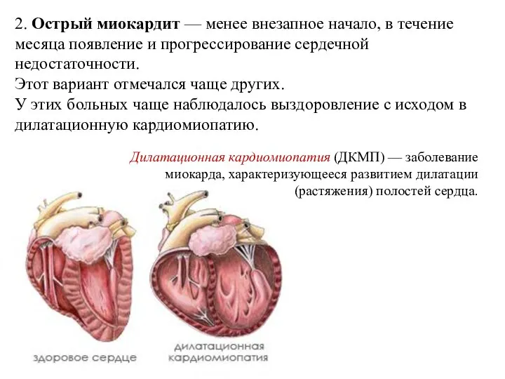 2. Острый миокардит — менее внезапное начало, в течение месяца появление