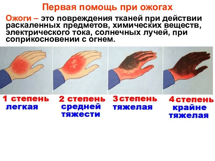 Первая помощь при ожогах Ожоги – это повреждения тканей при действии