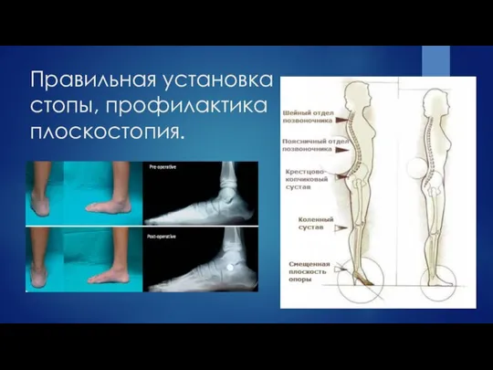 Правильная установка стопы, профилактика плоскостопия.