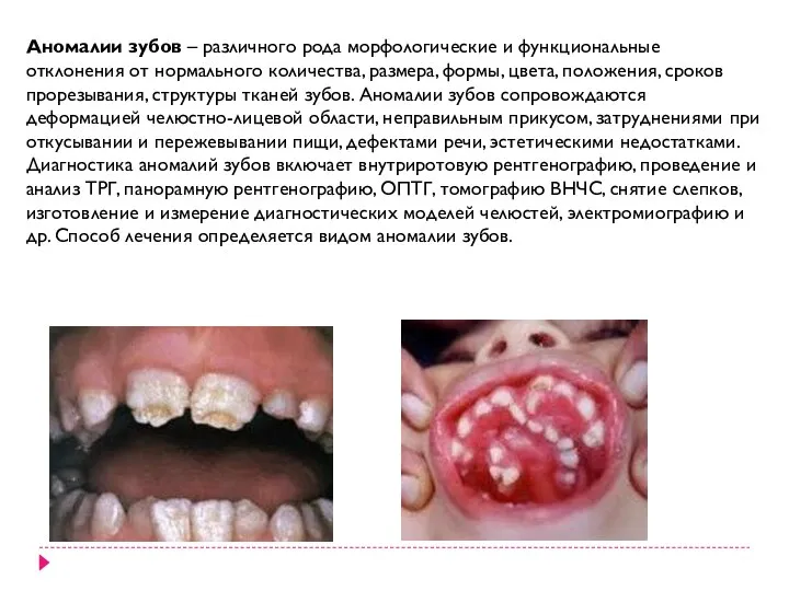 Аномалии зубов – различного рода морфологические и функциональные отклонения от нормального