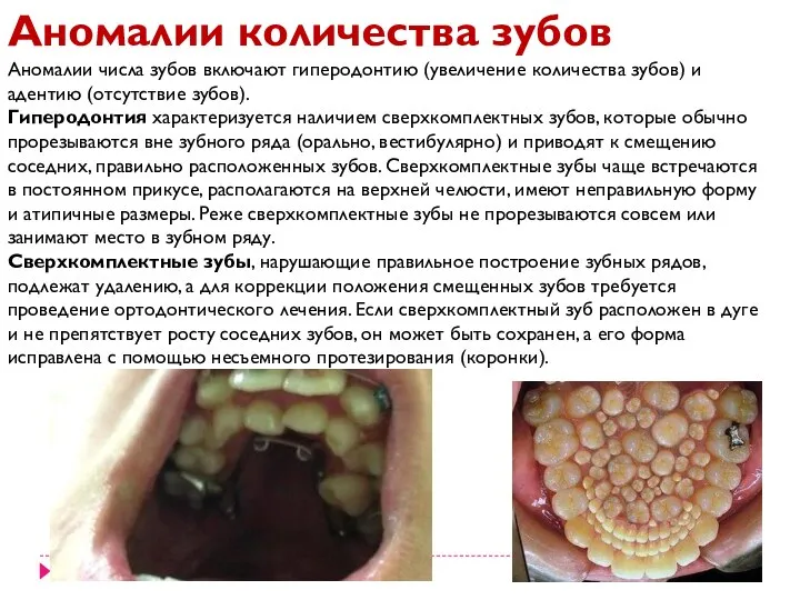 Аномалии количества зубов Аномалии числа зубов включают гиперодонтию (увеличение количества зубов)