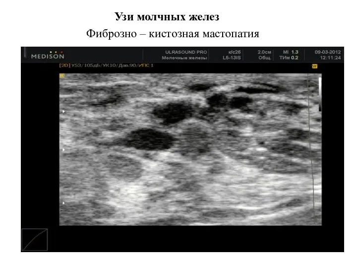 Узи молчных желез Фиброзно – кистозная мастопатия