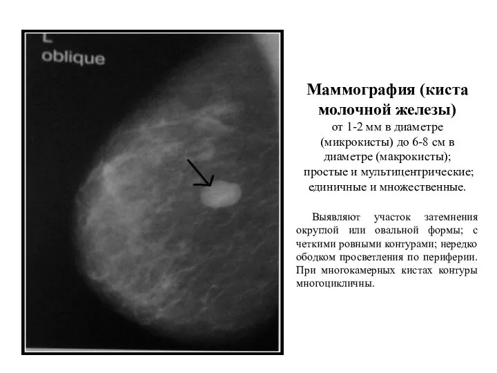 Маммография (киста молочной железы) от 1-2 мм в диаметре (микрокисты) до