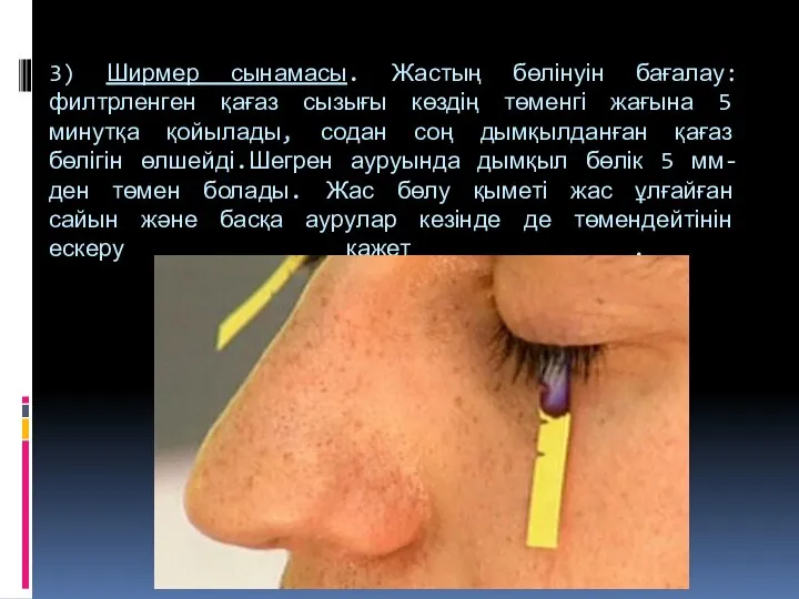 3) Ширмер сынамасы. Жастың бөлінуін бағалау:филтрленген қағаз сызығы көздің төменгі жағына