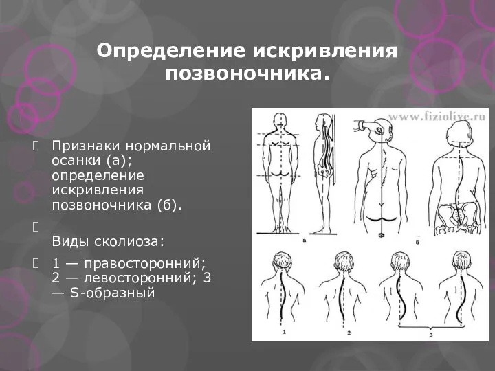 Определение искривления позвоночника. Признаки нормальной осанки (а); определение искривления позвоночника (б).