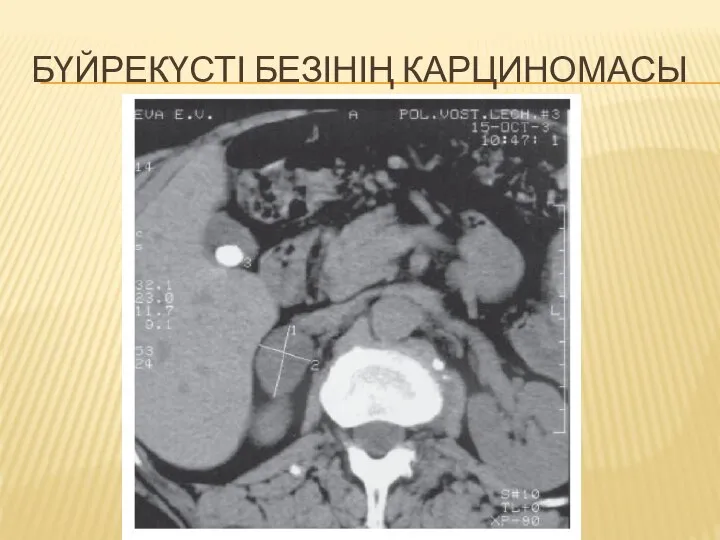 БҮЙРЕКҮСТІ БЕЗІНІҢ КАРЦИНОМАСЫ