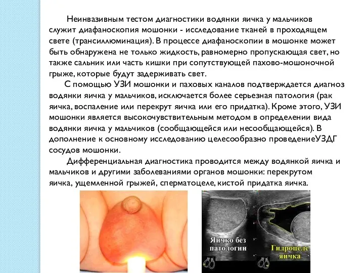 Неинвазивным тестом диагностики водянки яичка у мальчиков служит диафаноскопия мошонки -