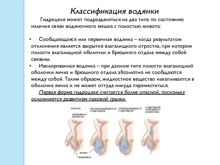 Классификация водянки Гидроцеле может подразделяться на два типа по состоянию наличия