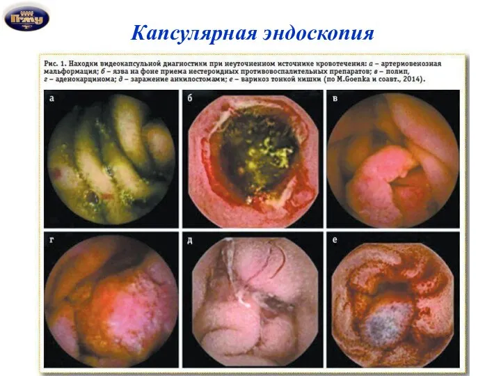 Капсулярная эндоскопия