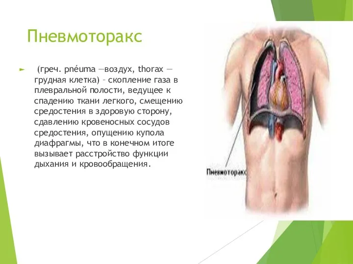 Пневмоторакс (греч. pnéuma —воздух, thorax — грудная клетка) – скопление газа