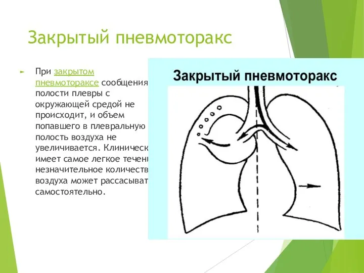 Закрытый пневмоторакс При закрытом пневмотораксе сообщения полости плевры с окружающей средой