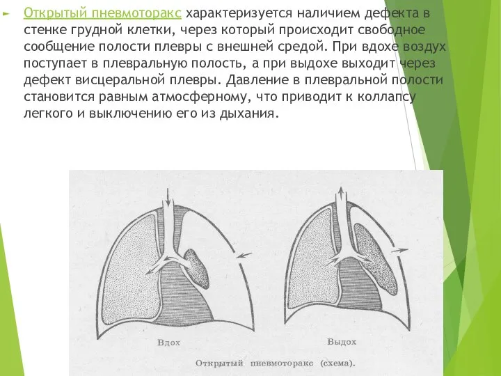 Открытый пневмоторакс характеризуется наличием дефекта в стенке грудной клетки, через который