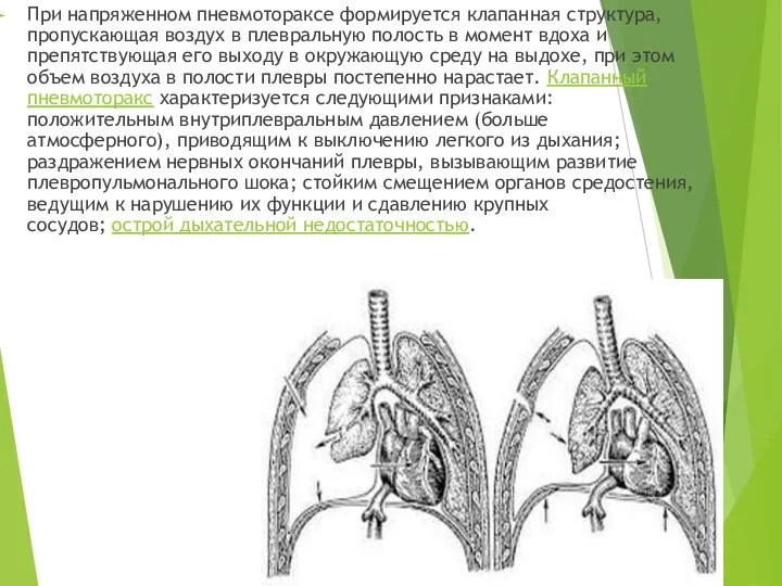 При напряженном пневмотораксе формируется клапанная структура, пропускающая воздух в плевральную полость