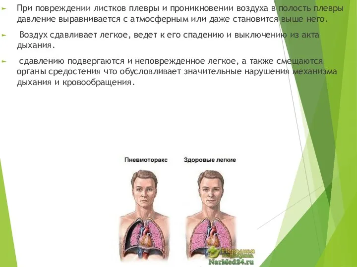 При повреждении листков плевры и проникновении воздуха в полость плевры давление