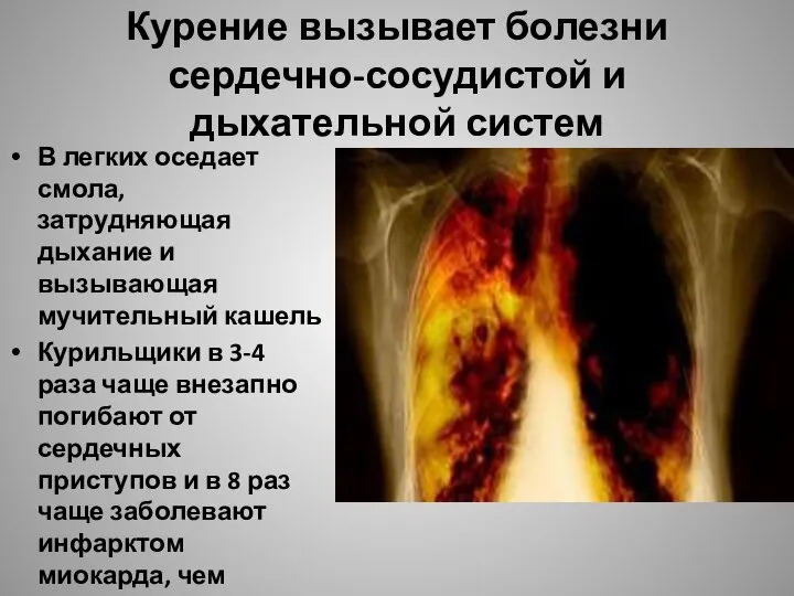 Курение вызывает болезни сердечно-сосудистой и дыхательной систем В легких оседает смола,