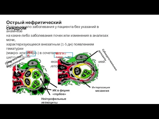 Острый нефритический синдром Острое начало заболевания у пациента без указаний в