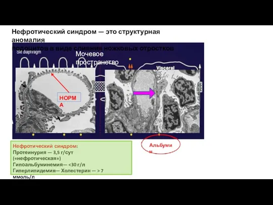 Мочевое пространство Альбумин Нефротический синдром — это структурная аномалия подоцитов в