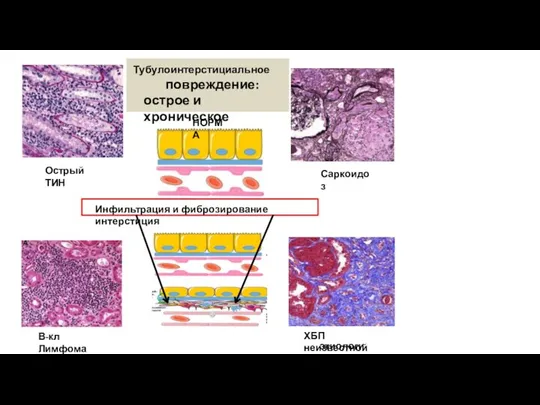 В-кл Лимфома Острый ТИН Саркоидоз ХБП неизвестной этиологии Тубулоинтерстициальное повреждение: острое