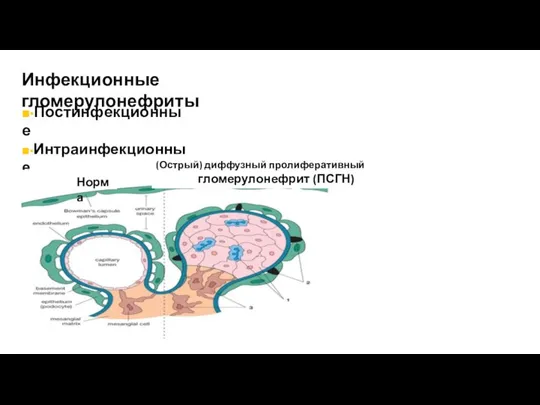 Инфекционные гломерулонефриты ■▪Постинфекционные ■▪Интраинфекционные (Острый) диффузный пролиферативный гломерулонефрит (ПСГН) Норма