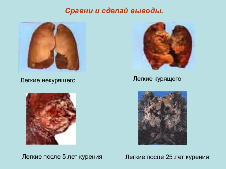 Сравни и сделай выводы. Легкие некурящего Легкие курящего Легкие после 5