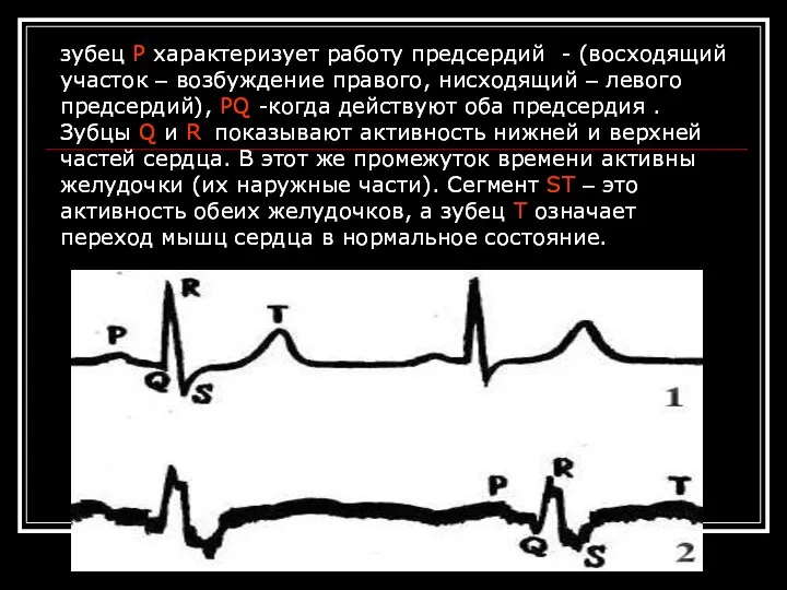 зубец Р характеризует работу предсердий - (восходящий участок – возбуждение правого,