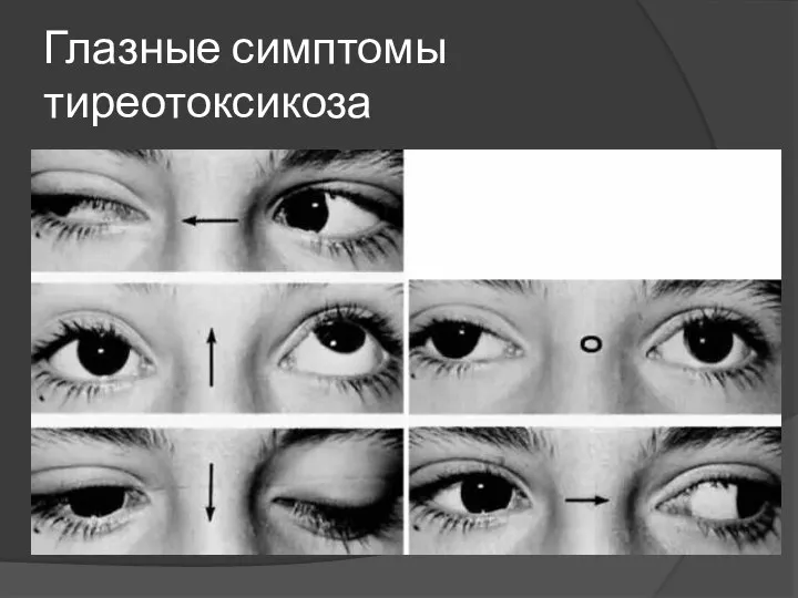 Глазные симптомы тиреотоксикоза