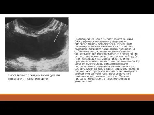 Пиосальпинкс чаще бывает двусторонним. Эхографическая картина у пациенток с пиосальпинксом отличается