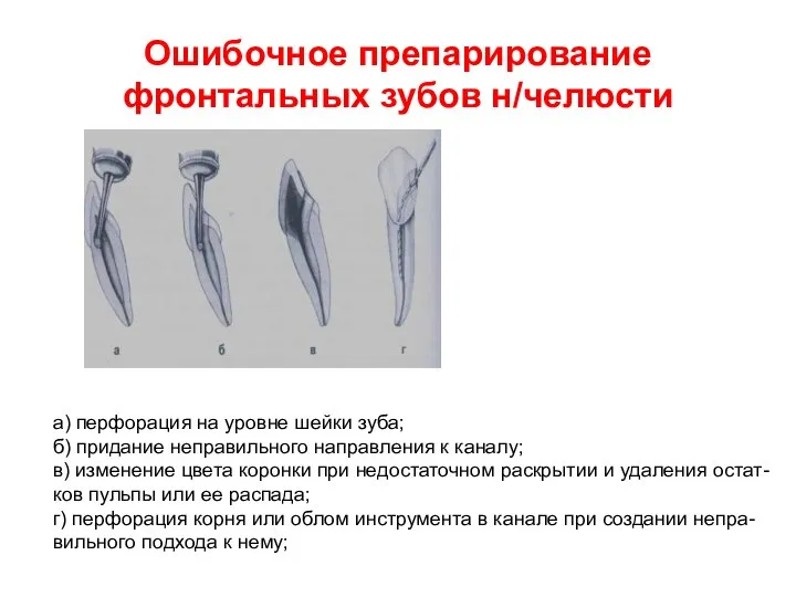 Ошибочное препарирование фронтальных зубов н/челюсти а) перфорация на уровне шейки зуба;