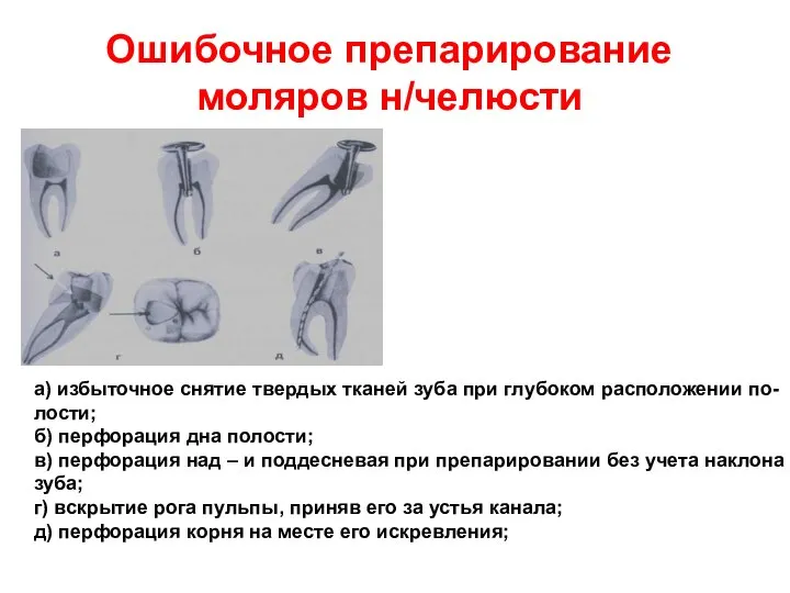 Ошибочное препарирование моляров н/челюсти а) избыточное снятие твердых тканей зуба при