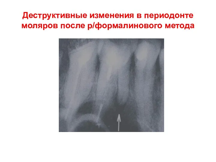 Деструктивные изменения в периодонте моляров после р/формалинового метода