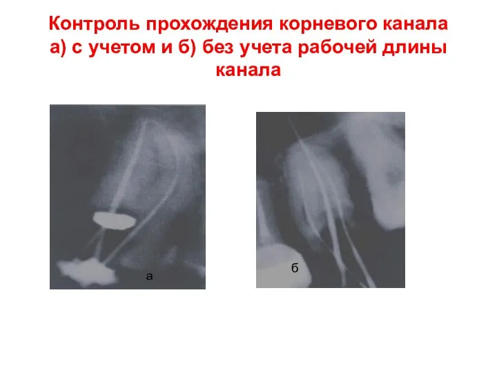 Контроль прохождения корневого канала а) с учетом и б) без учета рабочей длины канала а б