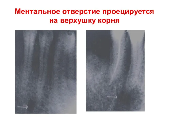 Ментальное отверстие проецируется на верхушку корня