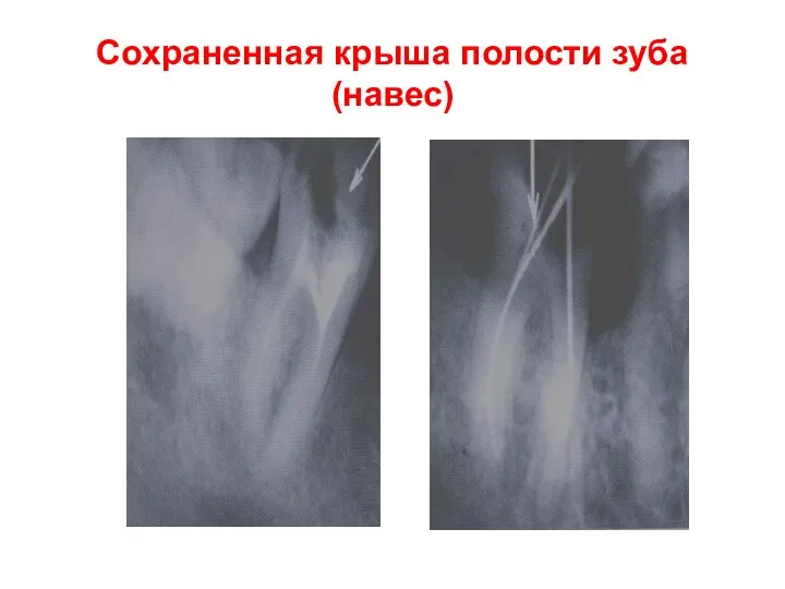 Сохраненная крыша полости зуба (навес)