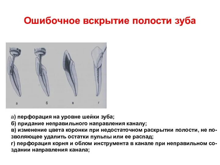 Ошибочное вскрытие полости зуба а) перфорация на уровне шейки зуба; б)