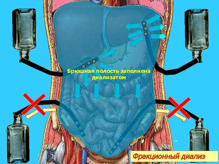 я Фракционный диализ Брюшная полость заполнена диализатом