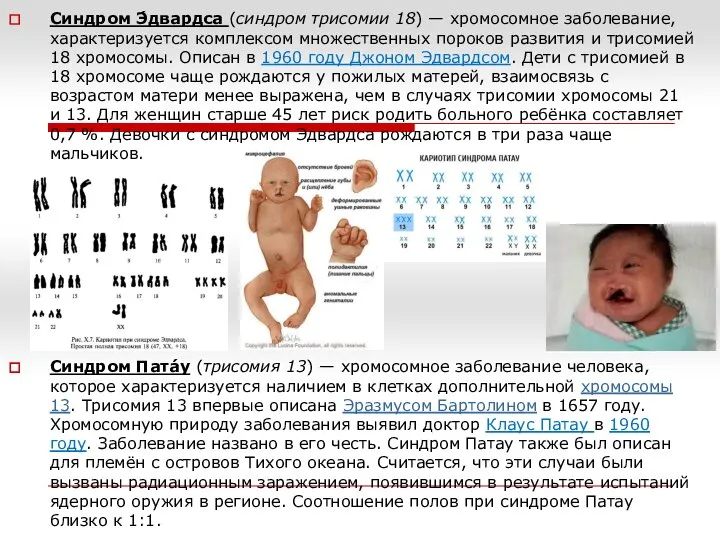 Синдром Э́двардса (синдром трисомии 18) — хромосомное заболевание, характеризуется комплексом множественных