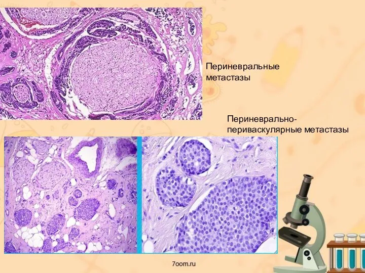 Периневральные метастазы Периневрально-периваскулярные метастазы