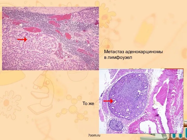 Метастаз аденокарциномы в лимфоузел То же